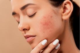 5 Bahan Skincare yang Harus Dihindari Pemilik Kulit Berjerawat